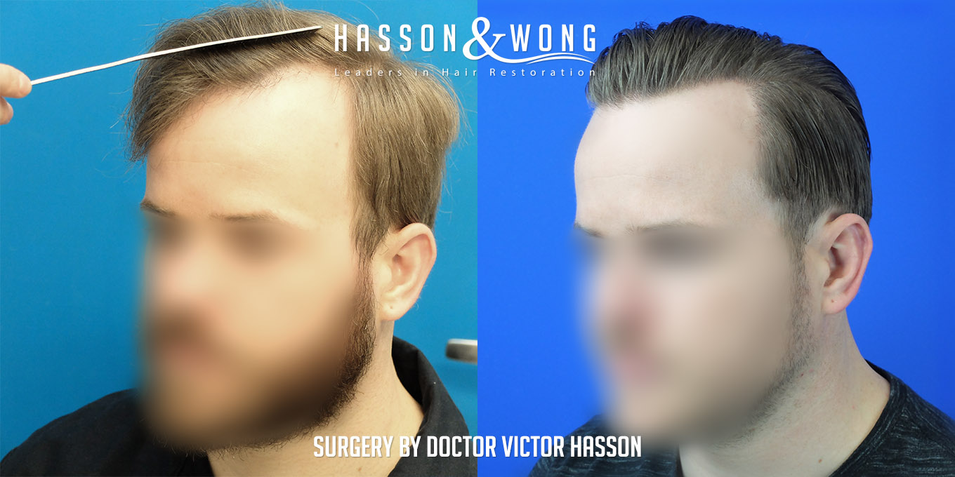 ts-drh-fue-hair-transplant-2640-grafts-left-before-after.jpg