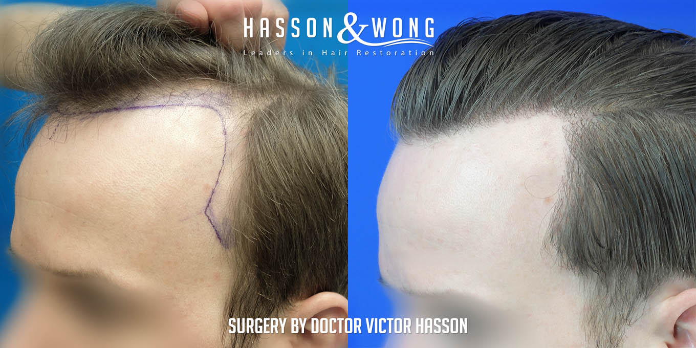 ts-drh-fue-hair-transplant-2640-grafts-left-close-before-after.jpg