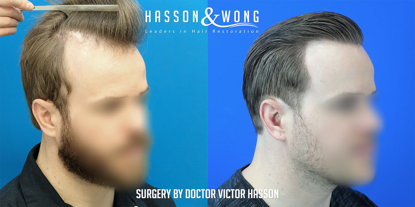 ts-drh-fue-hair-transplant-2640-grafts-right-before-after.jpg
