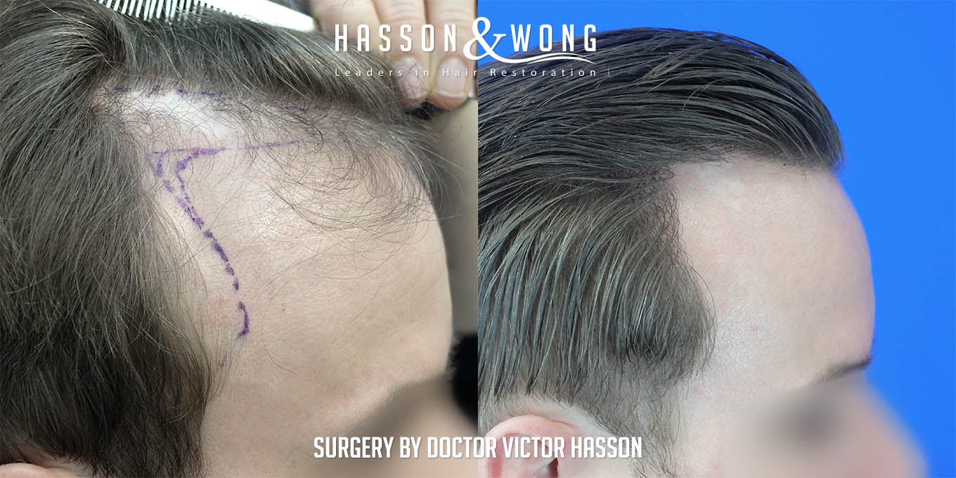 ts-drh-fue-hair-transplant-2640-grafts-right-close-before-after.jpg