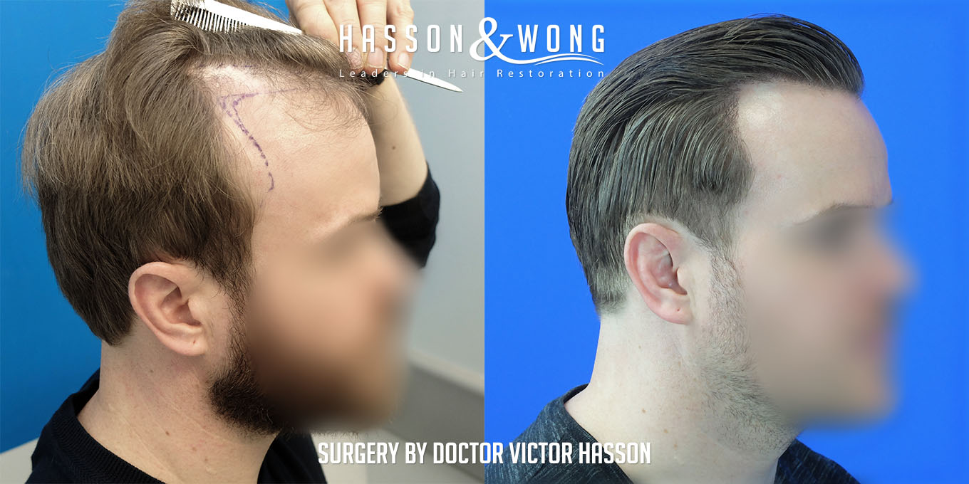 ts-drh-fue-hair-transplant-2640-grafts-right-profile-before-after.jpg
