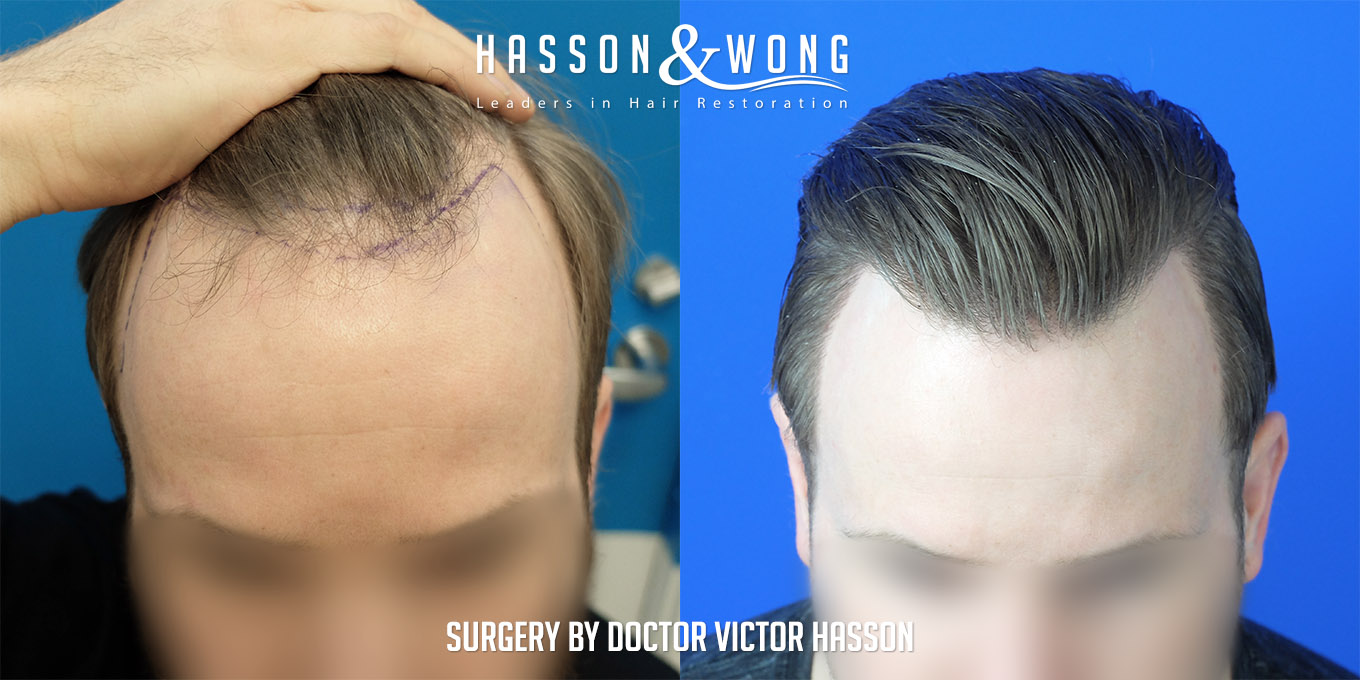 ts-drh-fue-hair-transplant-2640-grafts-tilt-before-after.jpg