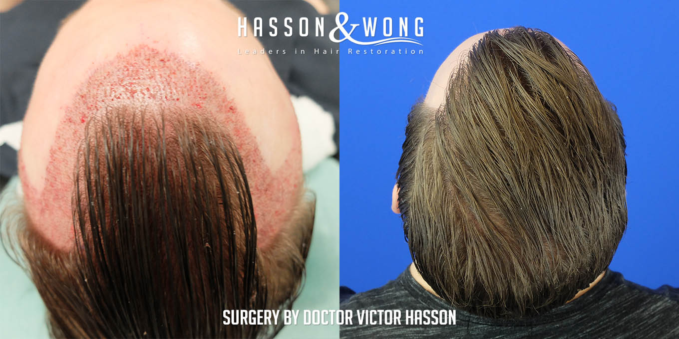 ts-drh-fue-hair-transplant-2640-grafts-top-before-after.jpg