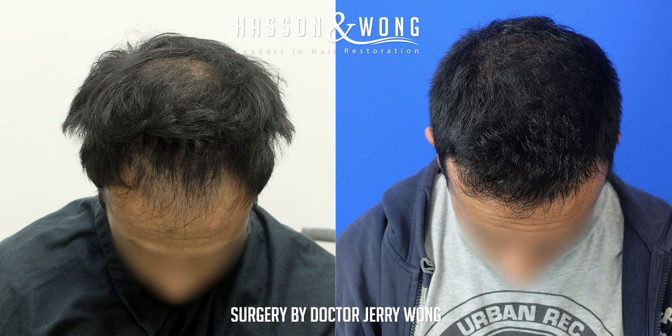 hair-restoration-before-after-3576-grafts-tilt-FUT.jpg