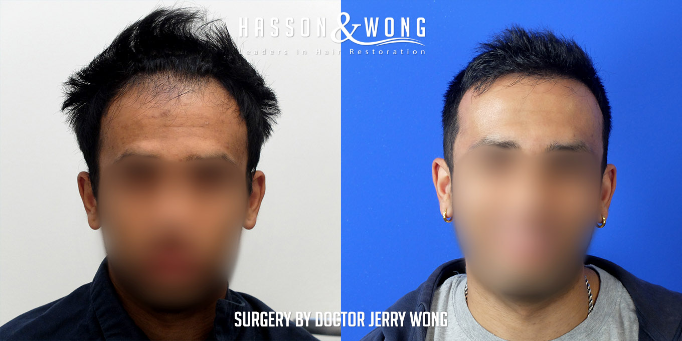 hair-transplant-before-after-3576-grafts-front-FUT.jpg