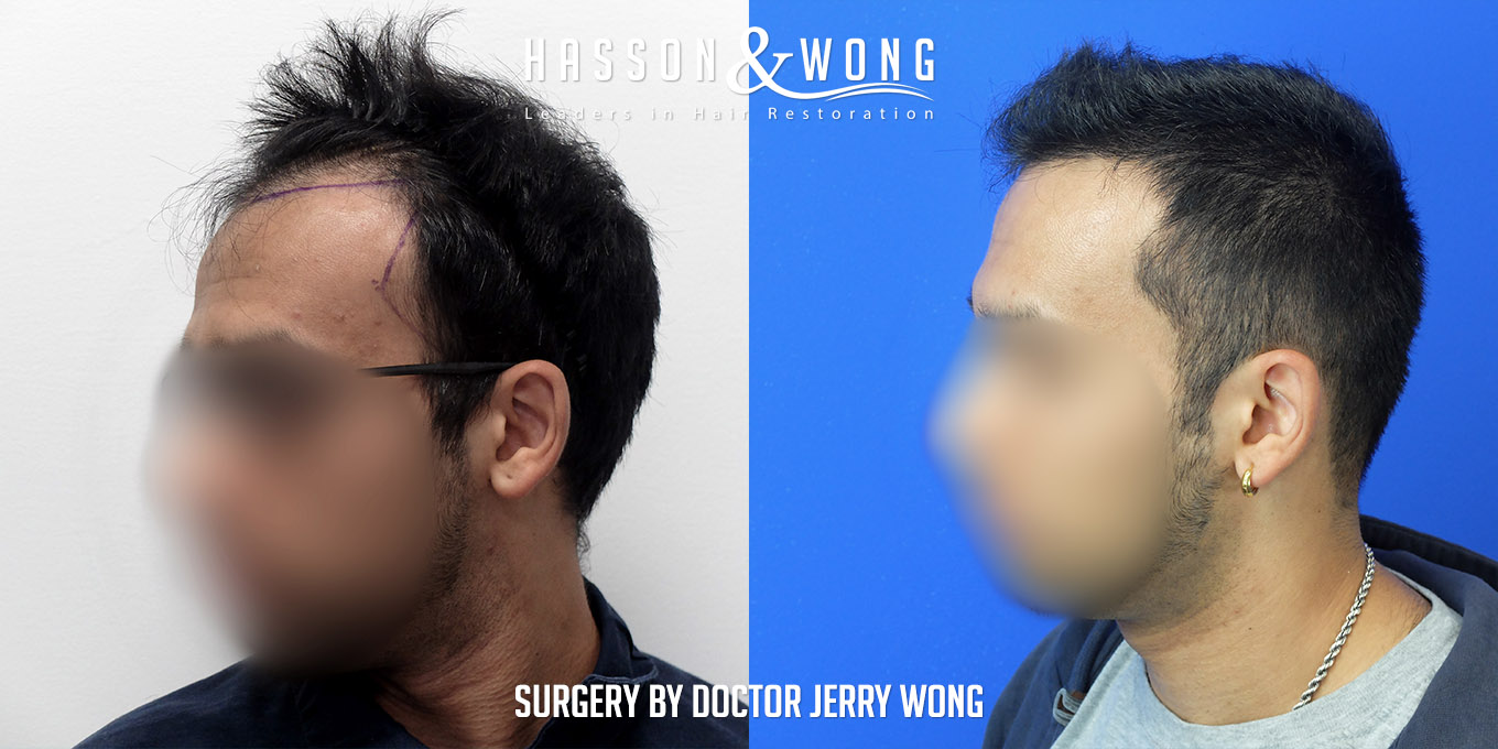 hair-transplant-before-after-3576-grafts-left-2-FUT.jpg