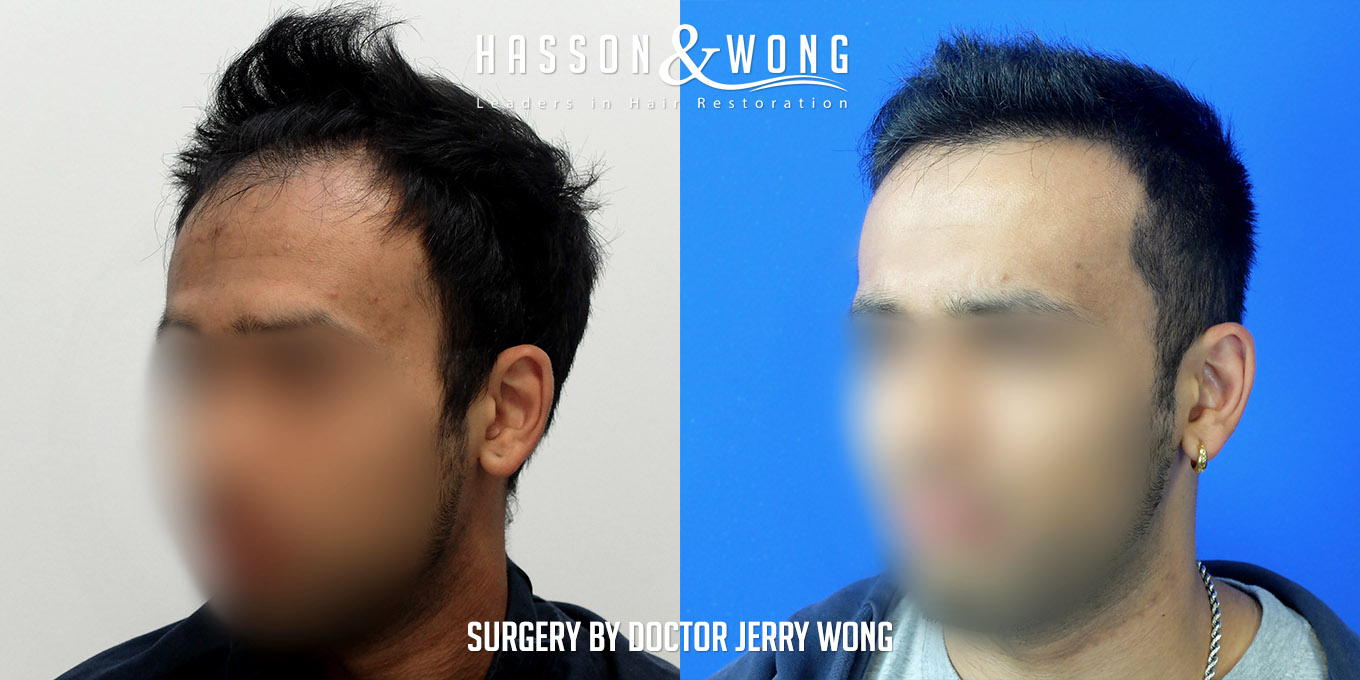 hair-transplant-before-after-3576-grafts-left-FUT.jpg