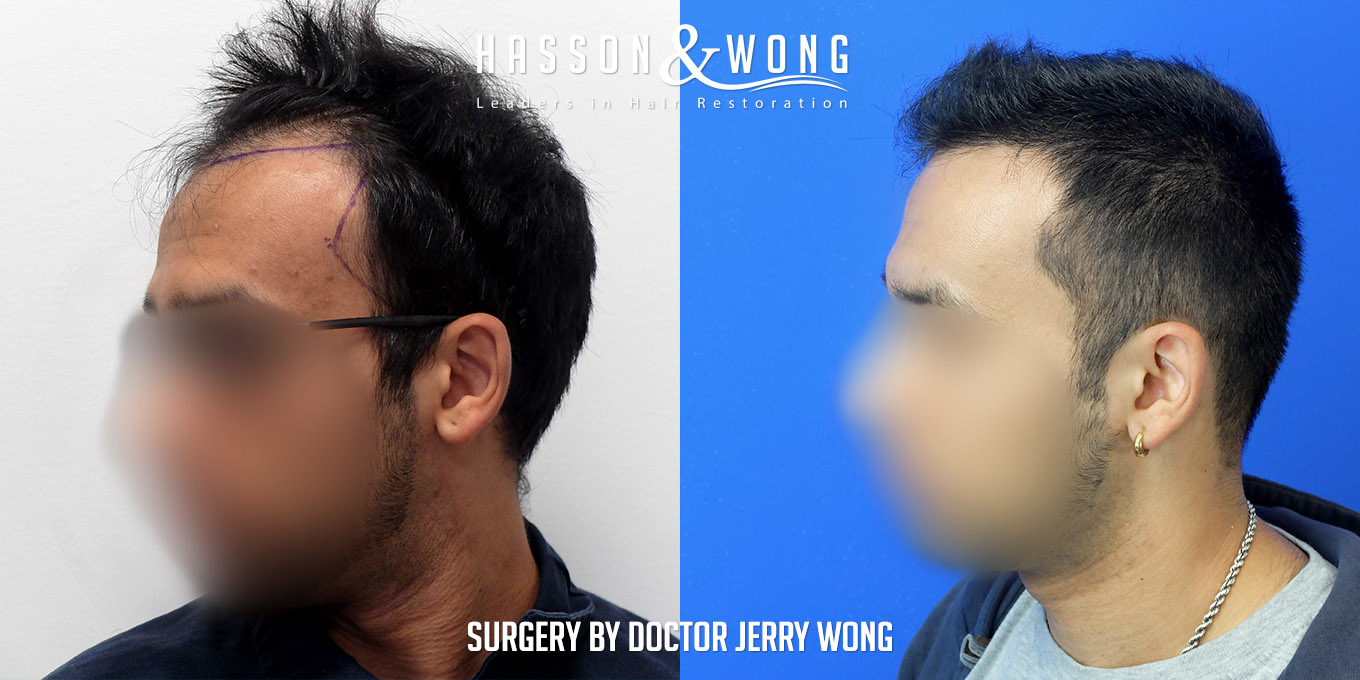 hair-transplant-before-after-3576-grafts-left-profile-FUT.jpg