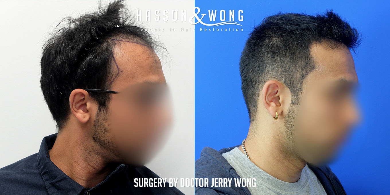 hair-transplant-before-after-3576-grafts-right-FUT.jpg