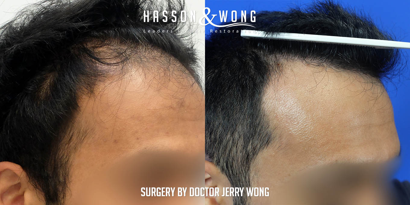hair-transplant-before-after-3576-grafts-right-close-FUT.jpg