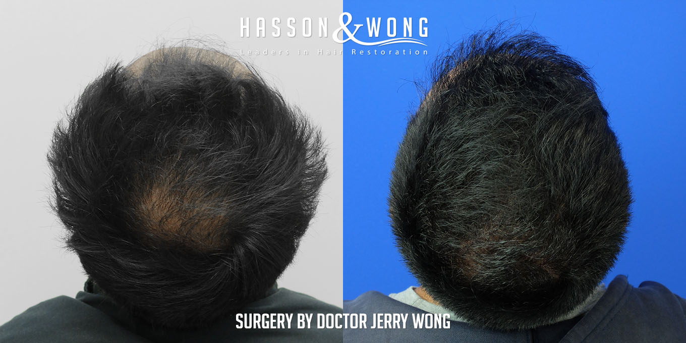 hair-transplant-before-after-3576-grafts-top-FUT.jpg