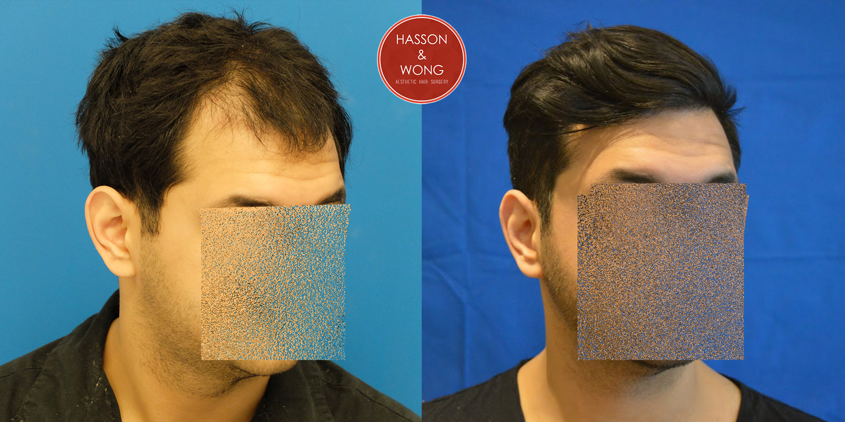 hair-transplant-before-and-after-dr-hass