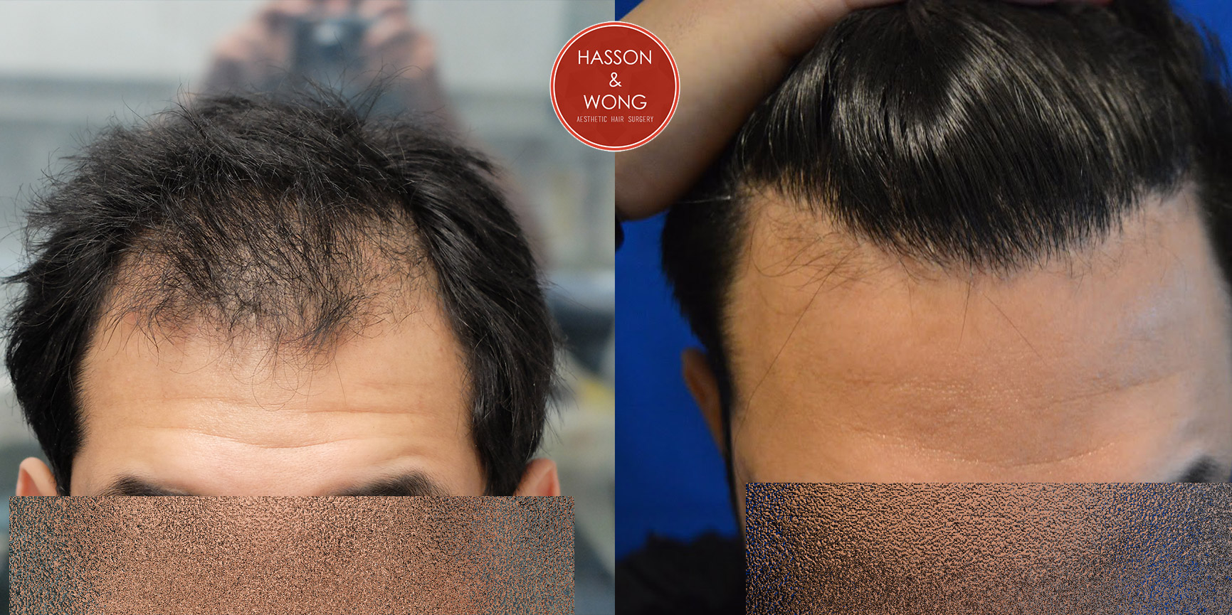 hair-transplant-before-and-after-dr-hasson--4.jpg