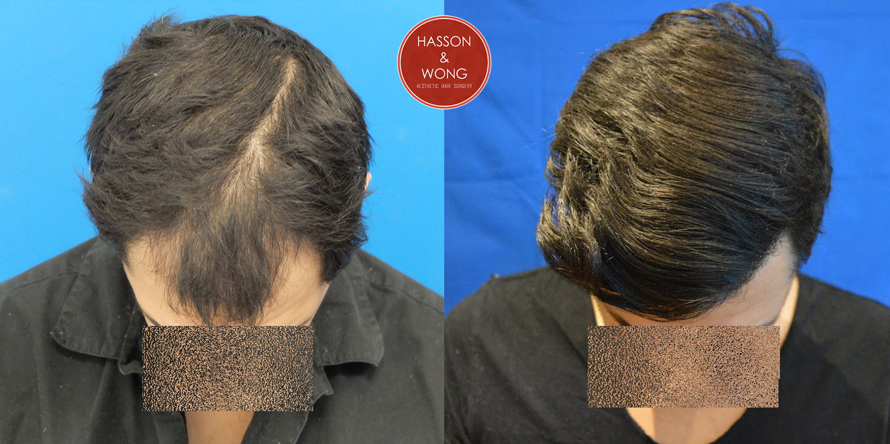 hair-transplant-before-and-after-dr-hass