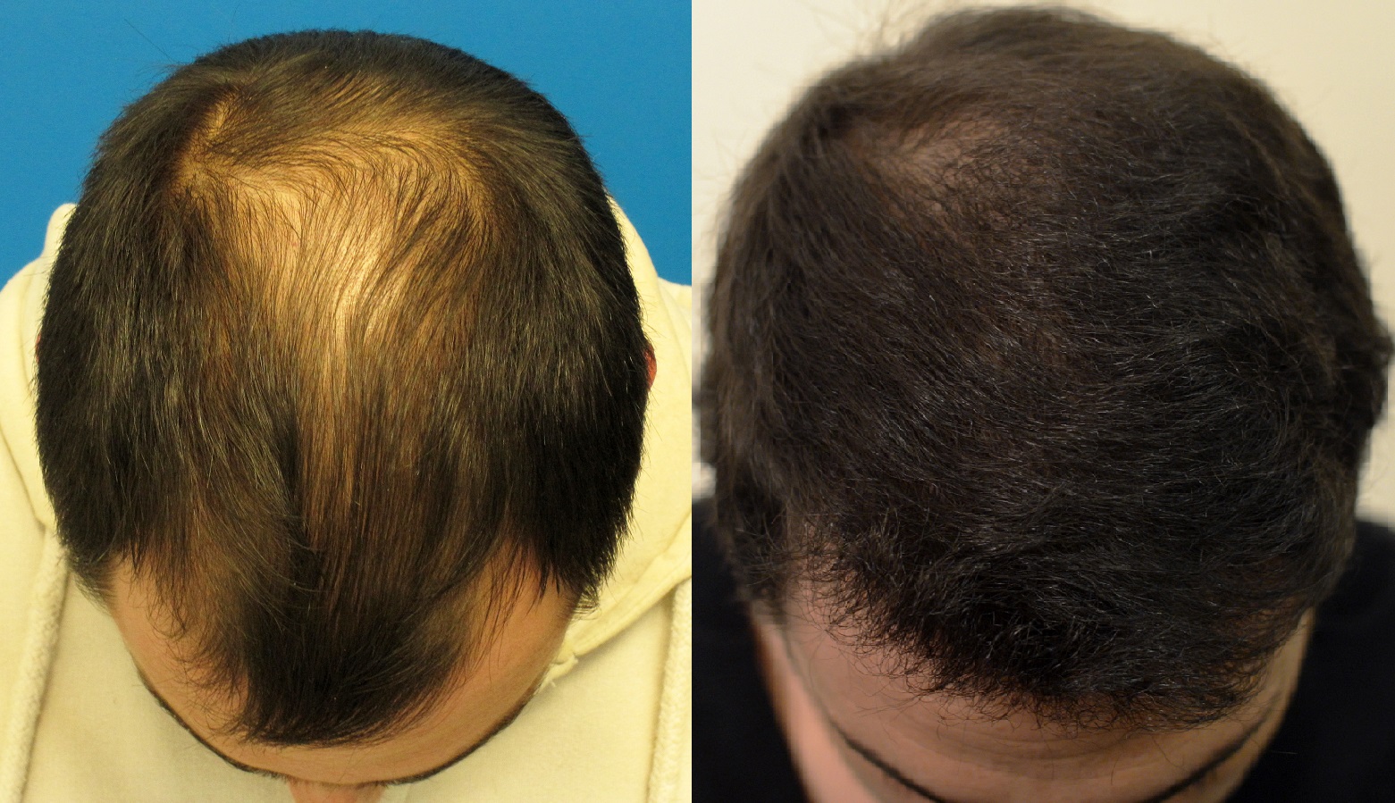 finasteride propecia proscar hair loss