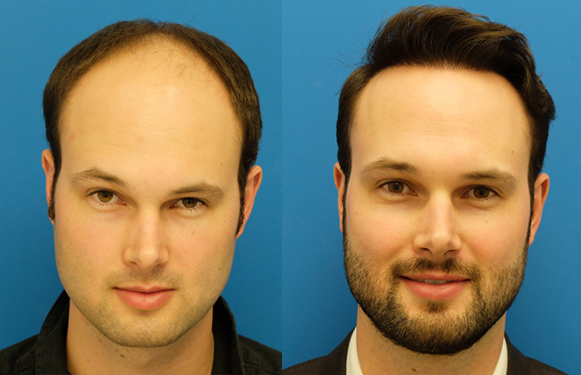How to find the Best Hair Transplant Doctor in Delhi