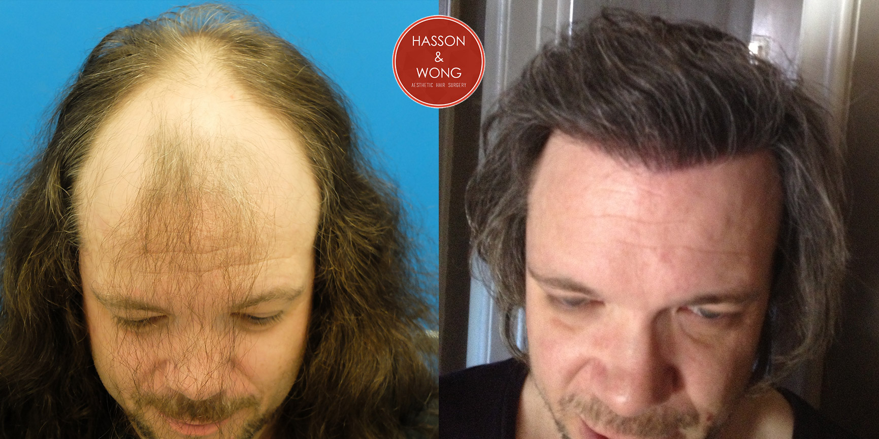 can you take finasteride before hair transplant