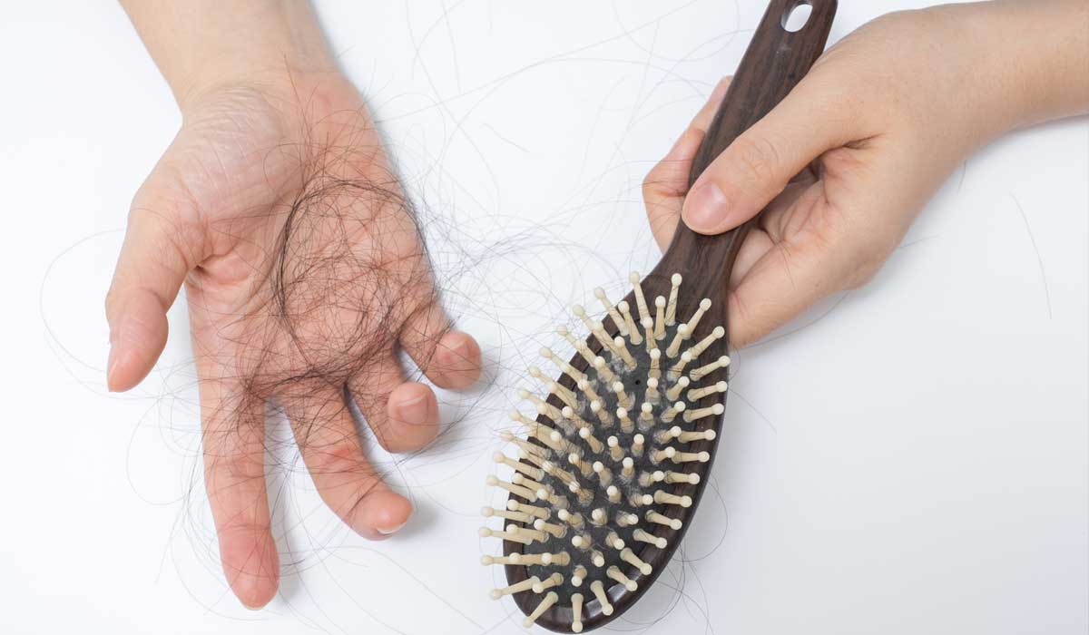 Pattern hair loss - Wikipedia