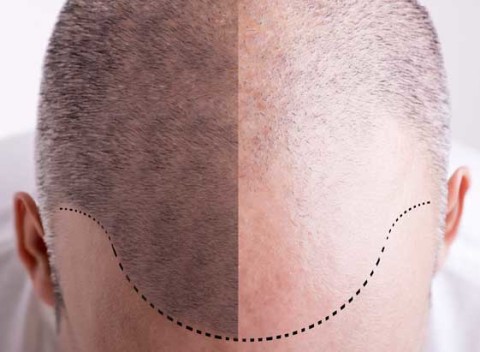 Male Pattern Hair Loss - Hair Loss In Men