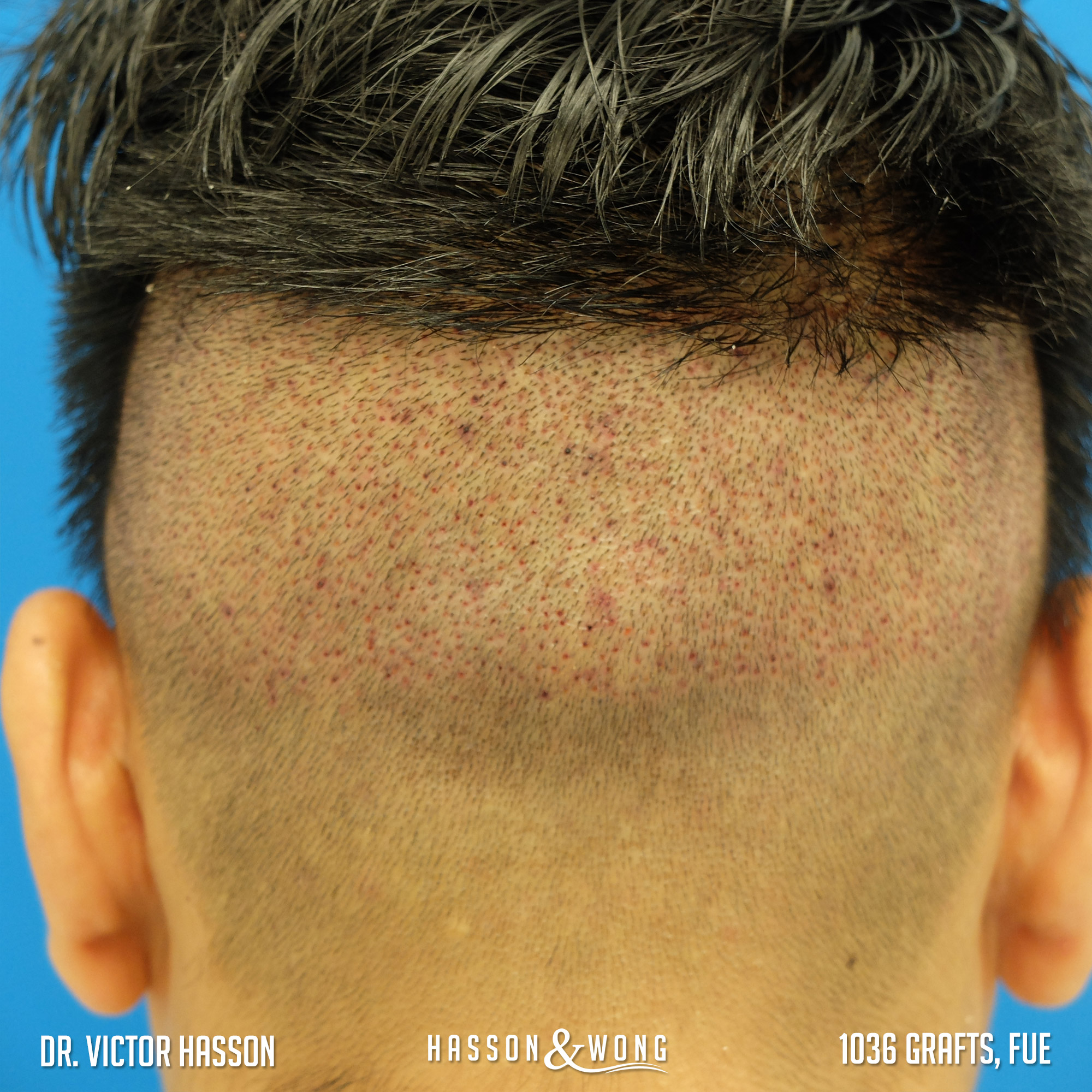 FUE Hair Transplant Timeline - Hasson & Wong