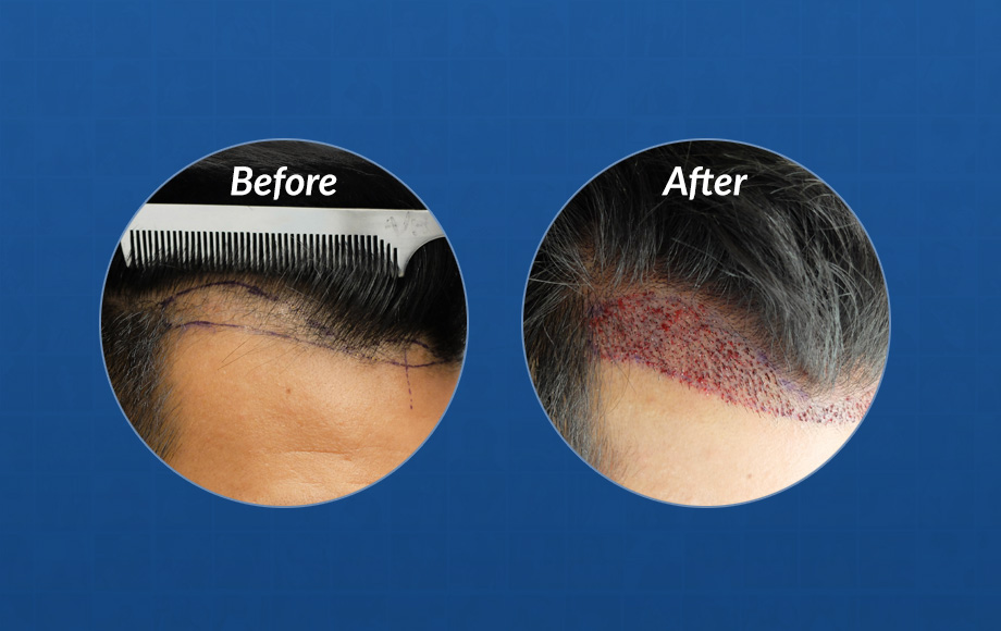 FUE Hair Transplant Timeline - Hasson & Wong