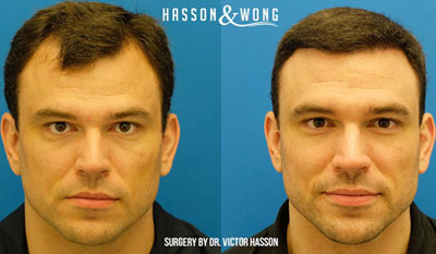 Some Of Our Favourite Transformations - Hair Transplant Before and After