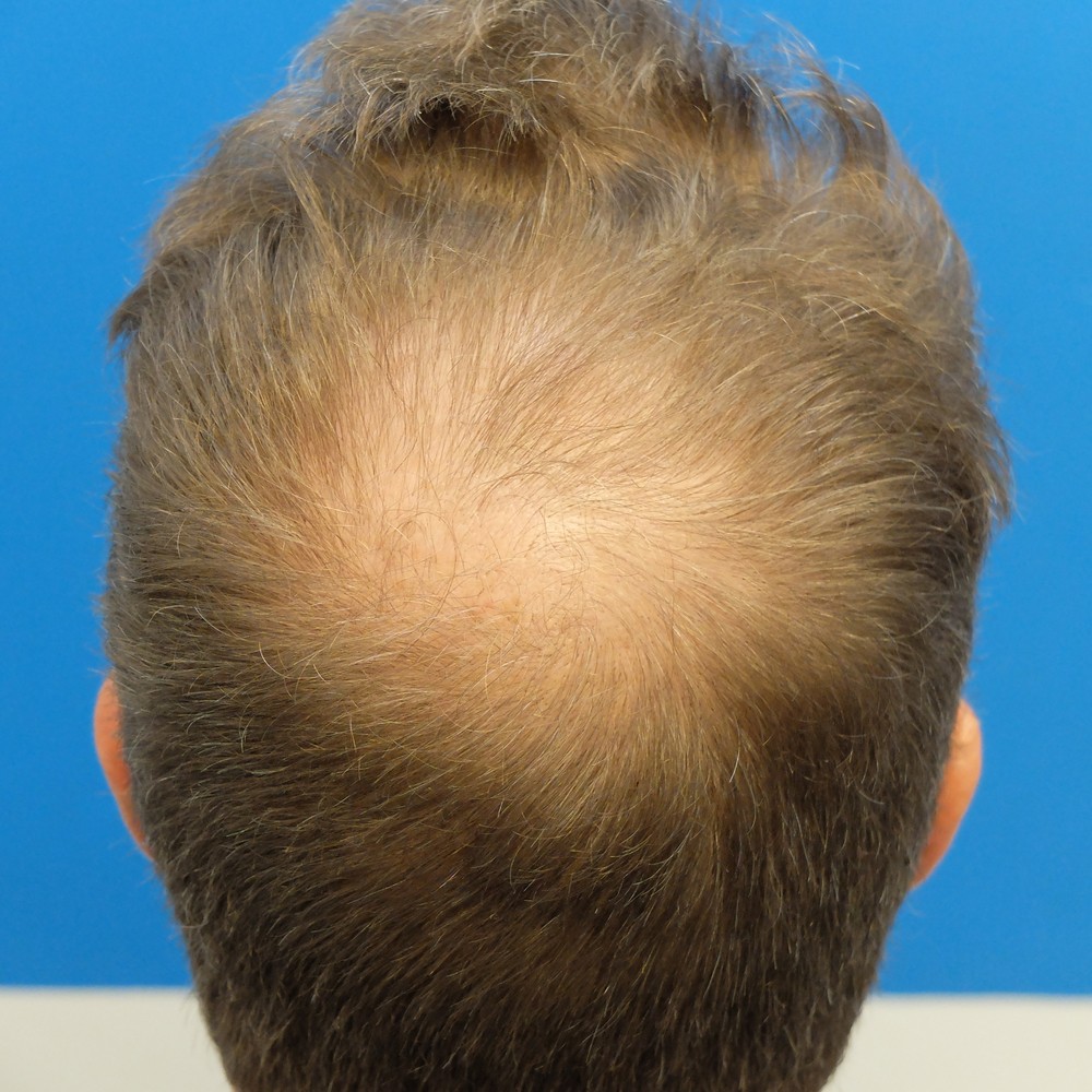 Hair Transplant Timeline | Over 6,000 Grafts! Follow This Patient's Journey!