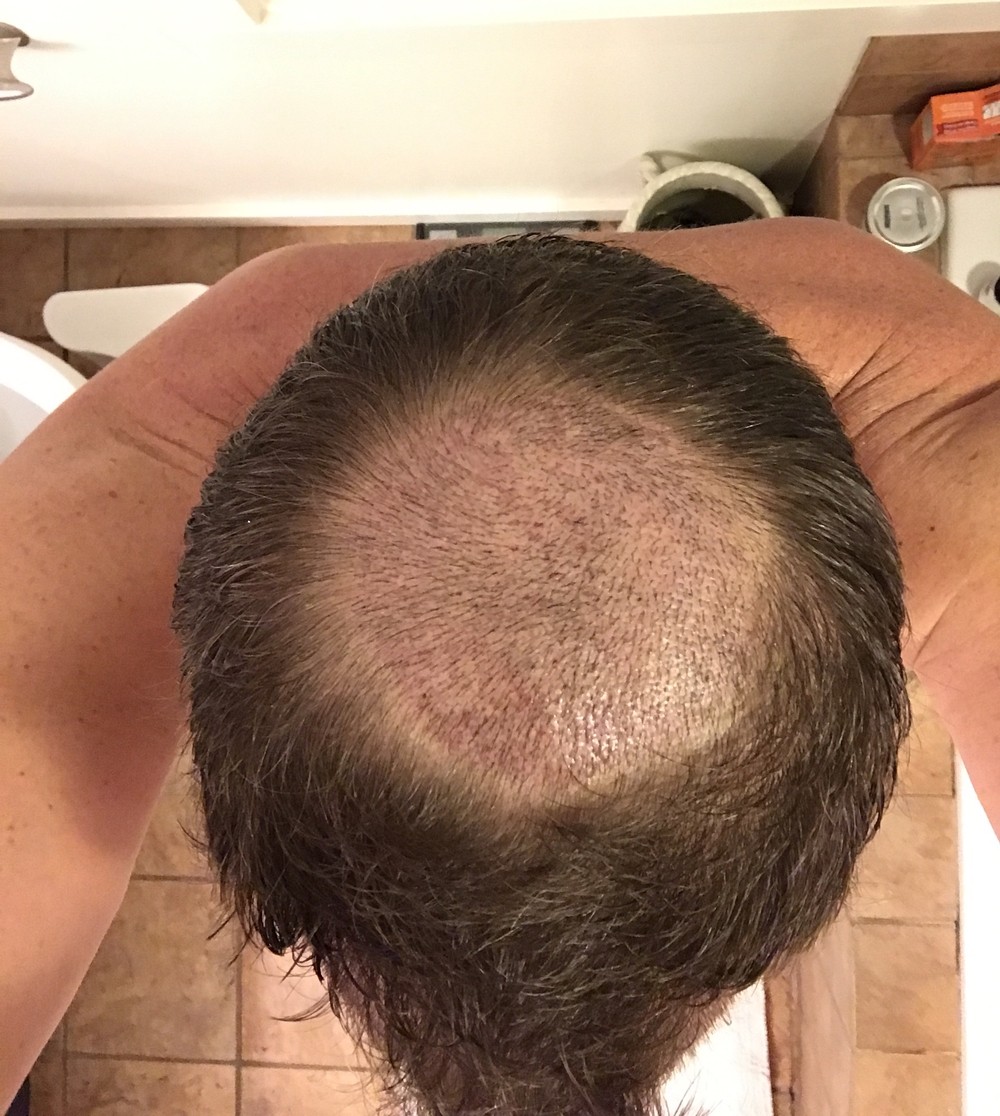 Hair Transplant Timeline | Over 6,000 Grafts! Follow This Patient's Journey!