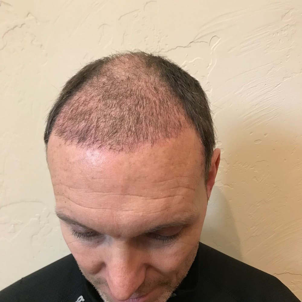 Stages Of Hair Transplant Growth | See This patient's Hair Grow After A  Transplant!