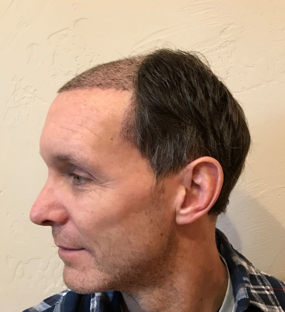 Stages Of Hair Transplant Growth | See This patient's Hair Grow After A  Transplant!