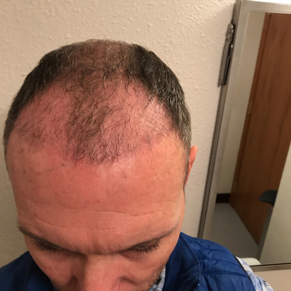 Post Op Recovery Photographs – 2 Weeks After FUE Hair Transplant