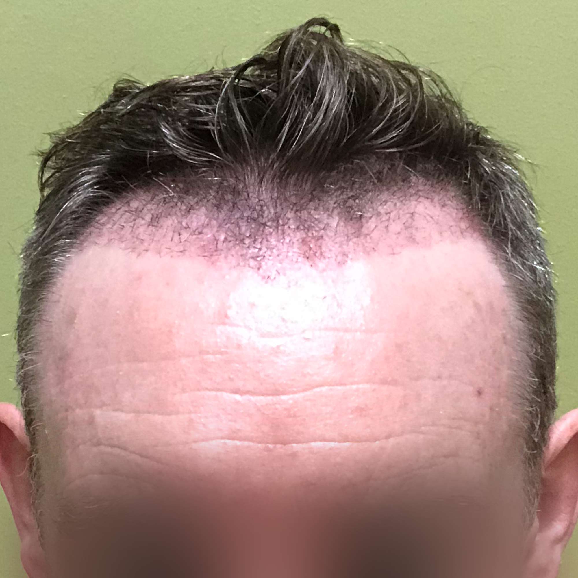 FUE Hair Transplant Timeline | Amazing Results At Only 6 Months!