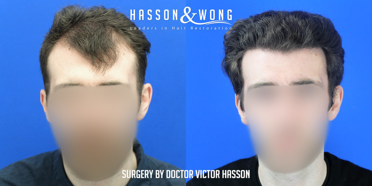 hair-restoration-surgery-before-after-2508-grafts-front-FUE-1200x600