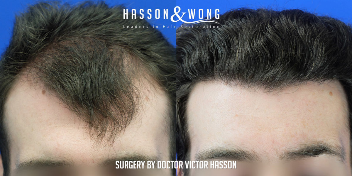 hair-restoration-surgery-before-after-2508-grafts-front-close-FUE-1200x600