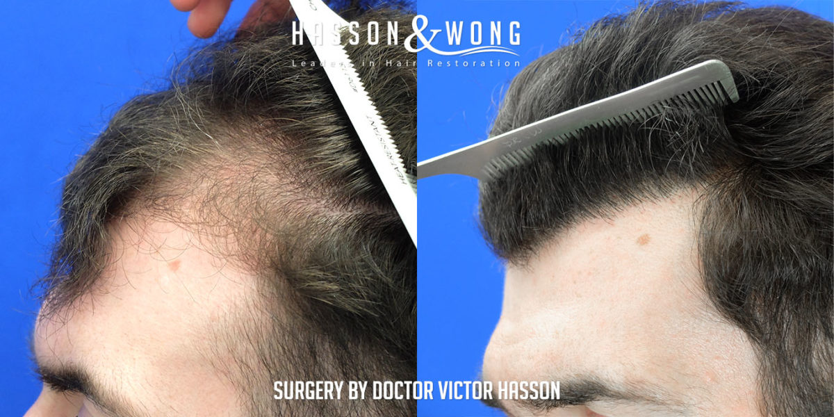 hair-restoration-surgery-before-after-2508-grafts-left-close-FUE-1200x600