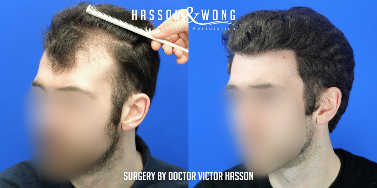 hair-transplant-surgery-before-after-2508-grafts-left-FUE-1200x600