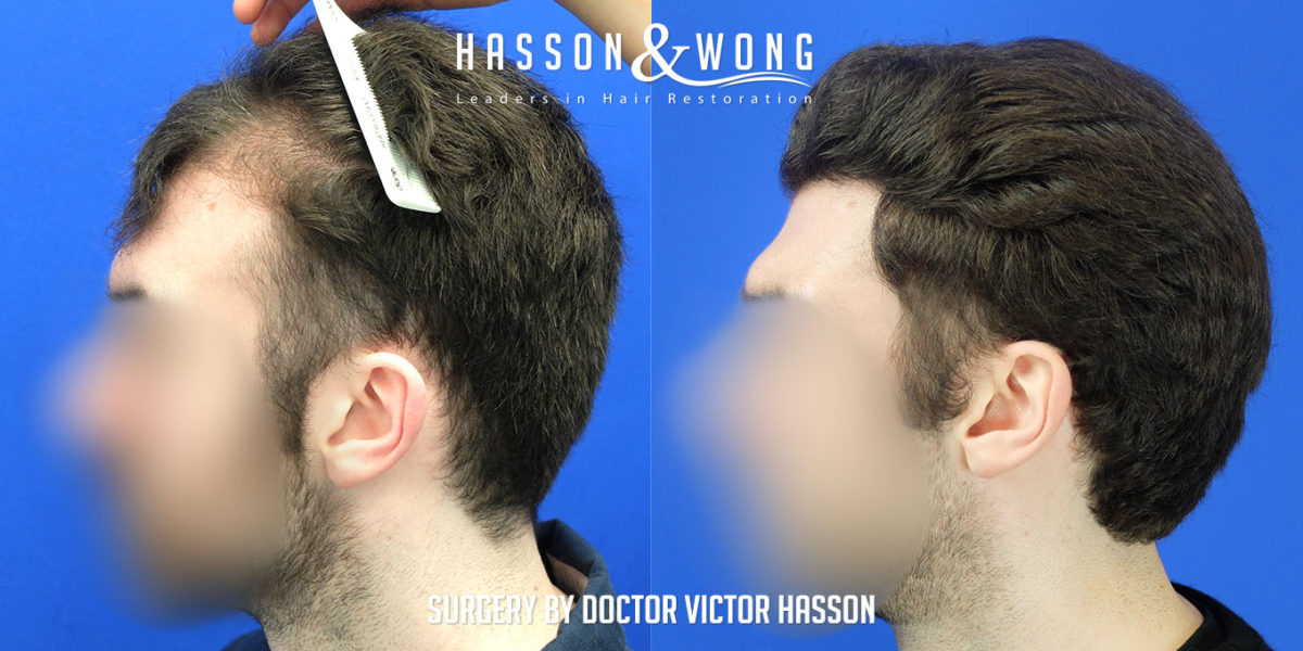hair-transplant-surgery-before-after-2508-grafts-left-profile-FUE-1200x600