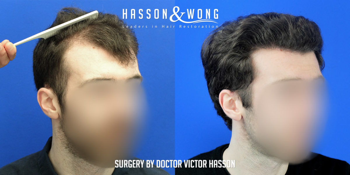 hair-transplant-surgery-before-after-2508-grafts-right-FUE-1200x600