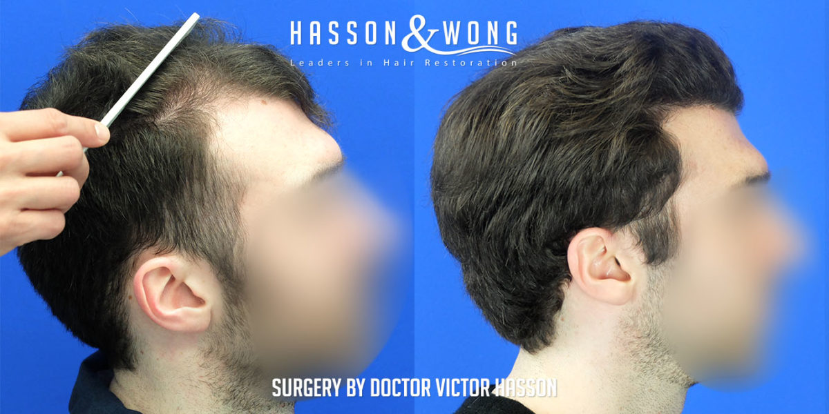 hair-transplant-surgery-before-after-2508-grafts-right-profile-FUE-1200x600