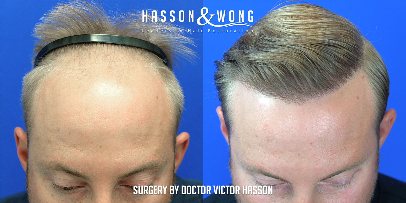 Hair Transplant Before and After - wide 8